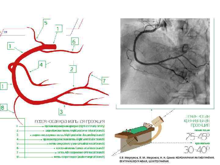 Е. В. Меркулов, В. М. Миронов, А. Н. Самко КОРОНАРНАЯ АНГИОГРАФИЯ, ВЕНТРИКУЛОГРАФИЯ, ШУНТОГРАФИЯ. 
