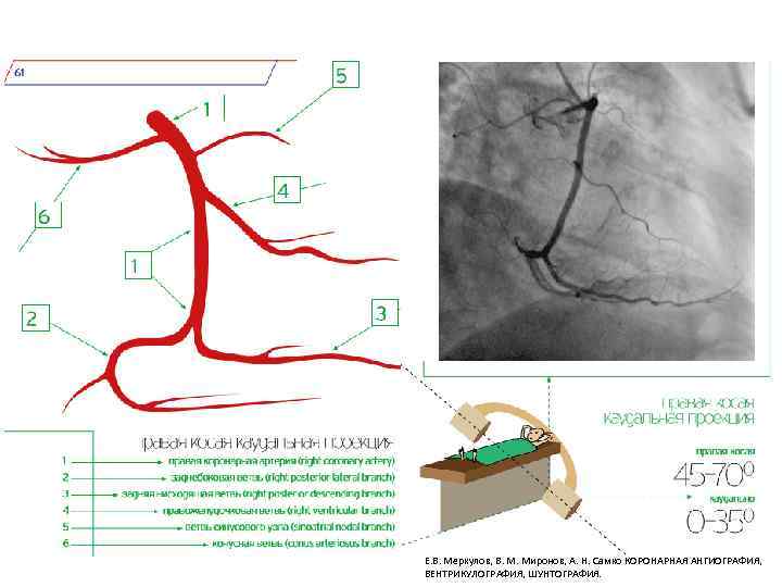 Е. В. Меркулов, В. М. Миронов, А. Н. Самко КОРОНАРНАЯ АНГИОГРАФИЯ, ВЕНТРИКУЛОГРАФИЯ, ШУНТОГРАФИЯ. 