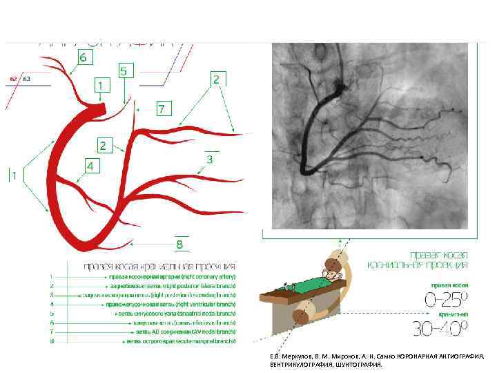 Е. В. Меркулов, В. М. Миронов, А. Н. Самко КОРОНАРНАЯ АНГИОГРАФИЯ, ВЕНТРИКУЛОГРАФИЯ, ШУНТОГРАФИЯ. 