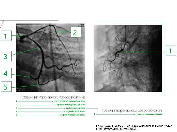 Е. В. Меркулов, В. М. Миронов, А. Н. Самко КОРОНАРНАЯ АНГИОГРАФИЯ, ВЕНТРИКУЛОГРАФИЯ, ШУНТОГРАФИЯ. 