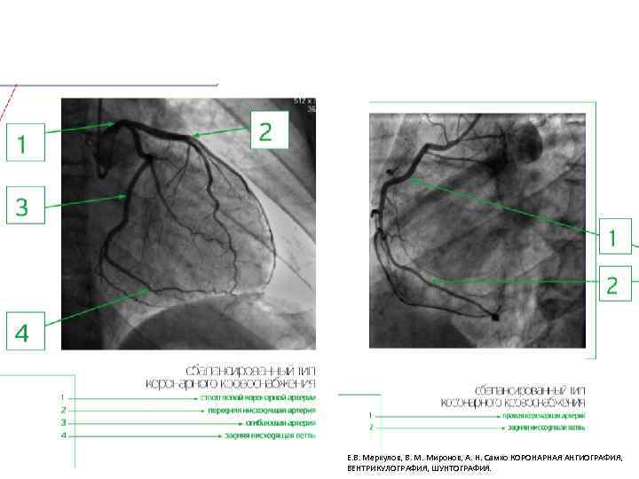 Е. В. Меркулов, В. М. Миронов, А. Н. Самко КОРОНАРНАЯ АНГИОГРАФИЯ, ВЕНТРИКУЛОГРАФИЯ, ШУНТОГРАФИЯ. 