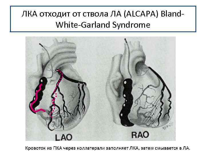 ЛКА отходит от ствола ЛА (ALCAPA) Bland. White-Garland Syndrome 