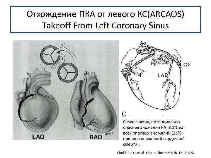 Отхождение ПКА от левого КС(ARCAOS) Takeoff From Left Coronary Sinus 