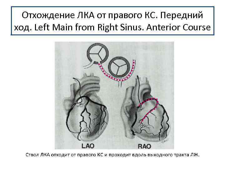 Отхождение ЛКА от правого КС. Передний ход. Left Main from Right Sinus. Anterior Coursе