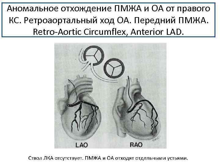 Аномальное отхождение ПМЖА и ОА от правого КС. Ретроаортальный ход ОА. Передний ПМЖА. Retro-Aortic