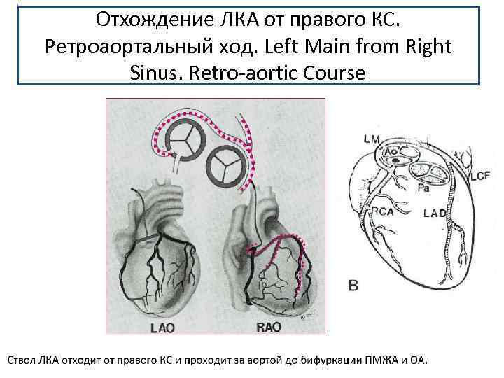 Отхождение ЛКА от правого КС. Ретроаортальный ход. Left Main from Right Sinus. Retro-aortic Course