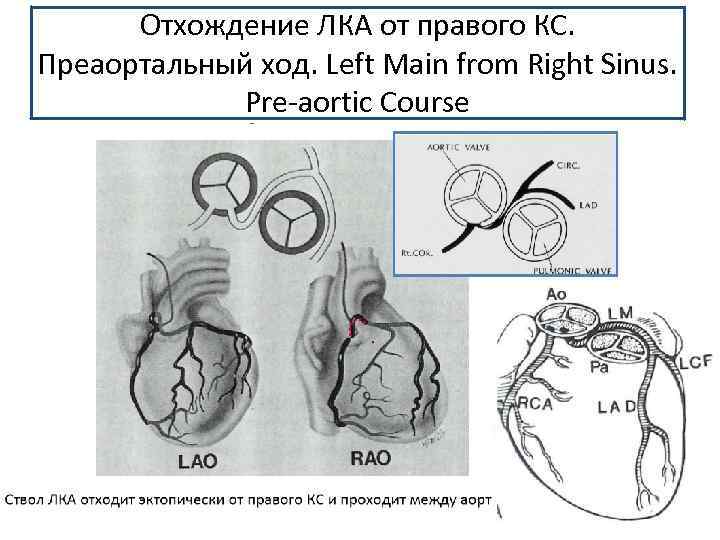 Отхождение ЛКА от правого КС. Преаортальный ход. Left Main from Right Sinus. Pre-aortic Course