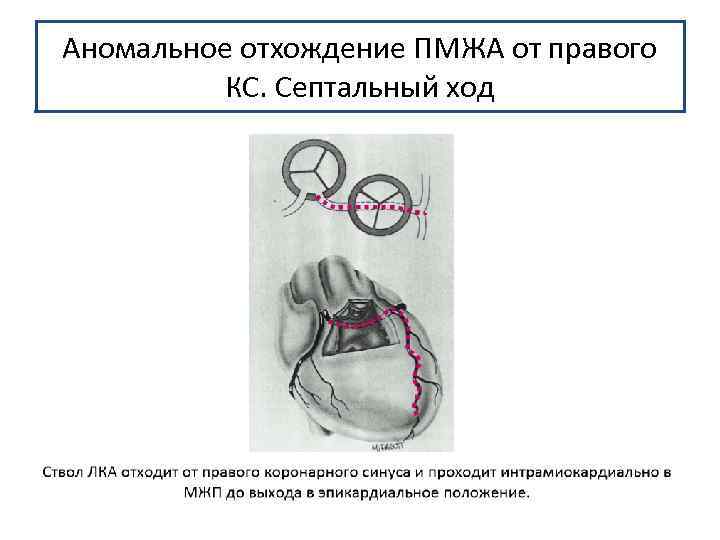 Аномальное отхождение ПМЖА от правого КС. Септальный ход 