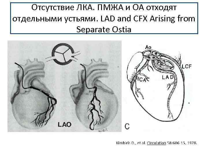 Отсутствие ЛКА. ПМЖА и ОА отходят отдельными устьями. LAD and CFX Arising from Separate
