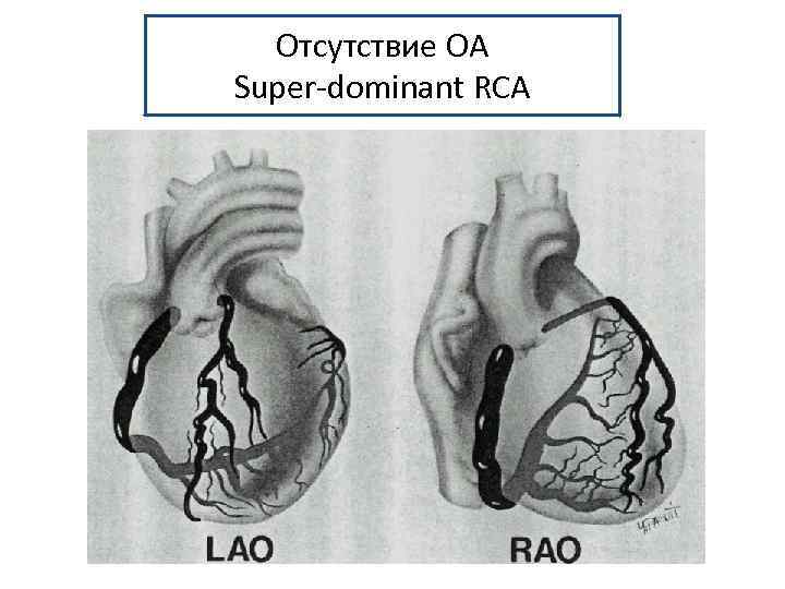 Отсутствие ОА Super-dominant RCA 