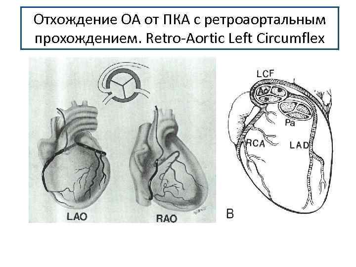 Отхождение ОА от ПКА с ретроаортальным прохождением. Retro-Aortic Left Circumflex 