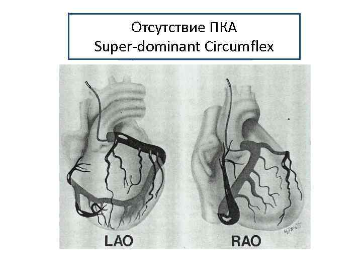 Отсутствие ПКА Super-dominant Circumflex 