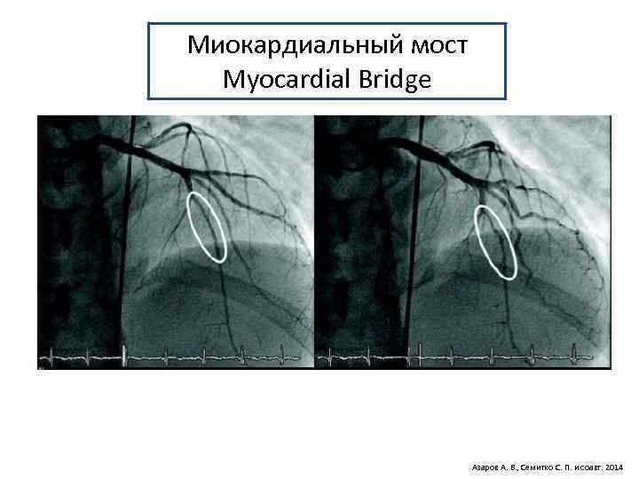 Миокардиальный мост Myocardial Bridge Азаров А. В. , Семитко С. П. и соавт. 2014