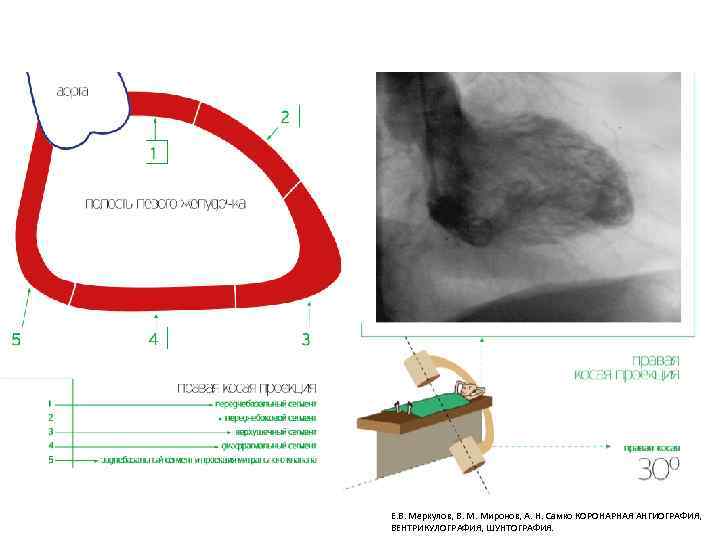 Е. В. Меркулов, В. М. Миронов, А. Н. Самко КОРОНАРНАЯ АНГИОГРАФИЯ, ВЕНТРИКУЛОГРАФИЯ, ШУНТОГРАФИЯ. 