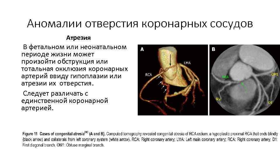 Аномалии отверстия коронарных сосудов Атрезия В фетальном или неонатальном периоде жизни может произойти обструкция
