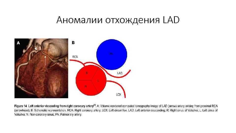 Аномалии отхождения LAD 