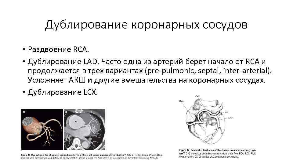 Дублирование коронарных сосудов • Раздвоение RCA. • Дублирование LAD. Часто одна из артерий берет