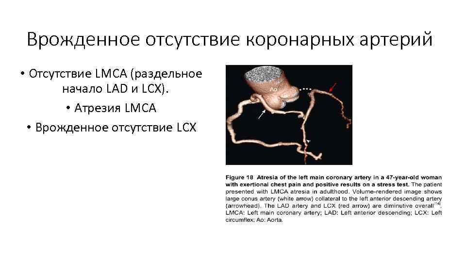 Врожденное отсутствие коронарных артерий • Отсутствие LMCA (раздельное начало LAD и LCX). • Атрезия