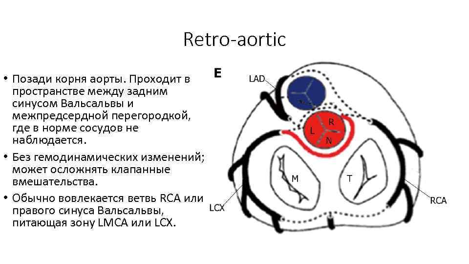 Retro-aortic • Позади корня аорты. Проходит в пространстве между задним синусом Вальсальвы и межпредсердной