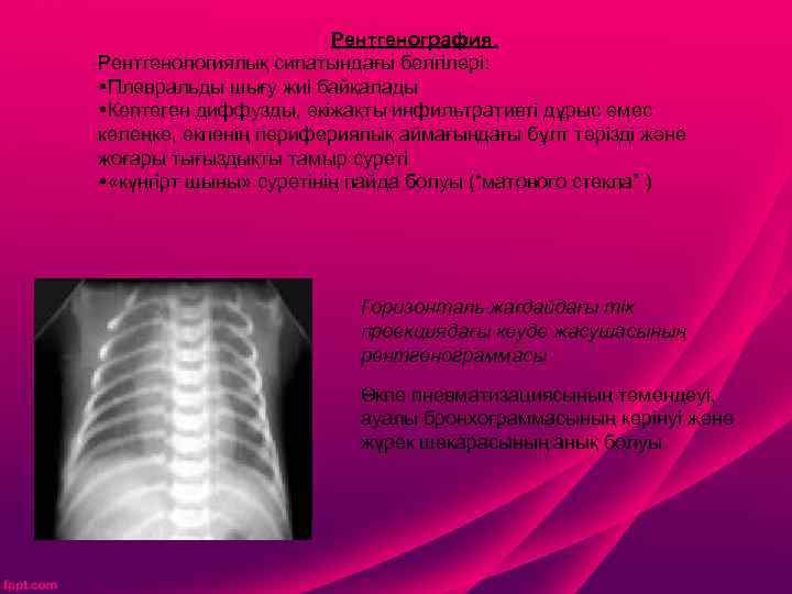 Рентгенография. Рентгенологиялық сипатындағы белгілері: §Плевральды шығу жиі байқалады §Көптеген диффузды, екіжақты инфильтративті дұрыс емес