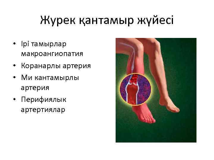 Журек қантамыр жүйесі • Ірі тамырлар макроангиопатия • Коранарлы артерия • Ми кантамырлы артерия