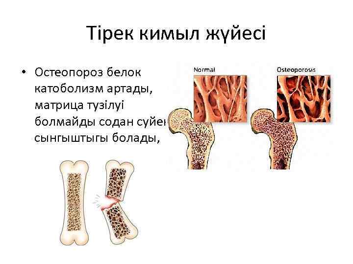 Тірек кимыл жүйесі • Остеопороз белок катоболизм артады, матрица тузілуі болмайды содан суйек сынгыштыгы