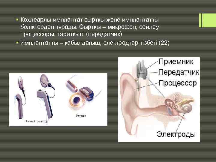 § Кохлеарлы имплантат сыртқы және имплантатты бөліктерден тұрады. Сыртқы – микрофон, сөйлеу процессоры, таратқыш