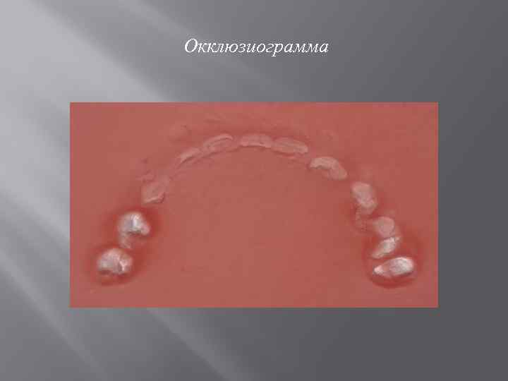 Окклюзиограмма 