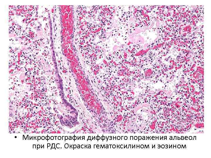  • Микрофотография диффузного поражения альвеол при РДС. Окраска гематоксилином и эозином 