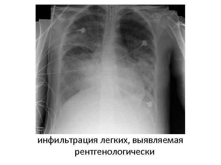 инфильтрация легких, выявляемая рентгенологически 