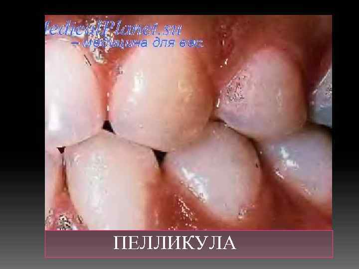  ПЕЛЛИКУЛА 