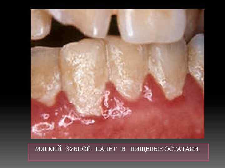  МЯГКИЙ ЗУБНОЙ НАЛЁТ И ПИЩЕВЫЕ ОСТАТАКИ 