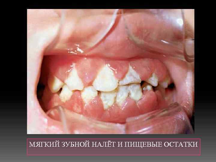 МЯГКИЙ ЗУБНОЙ НАЛЁТ И ПИЩЕВЫЕ ОСТАТКИ 