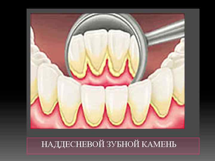  НАДДЕСНЕВОЙ ЗУБНОЙ КАМЕНЬ 