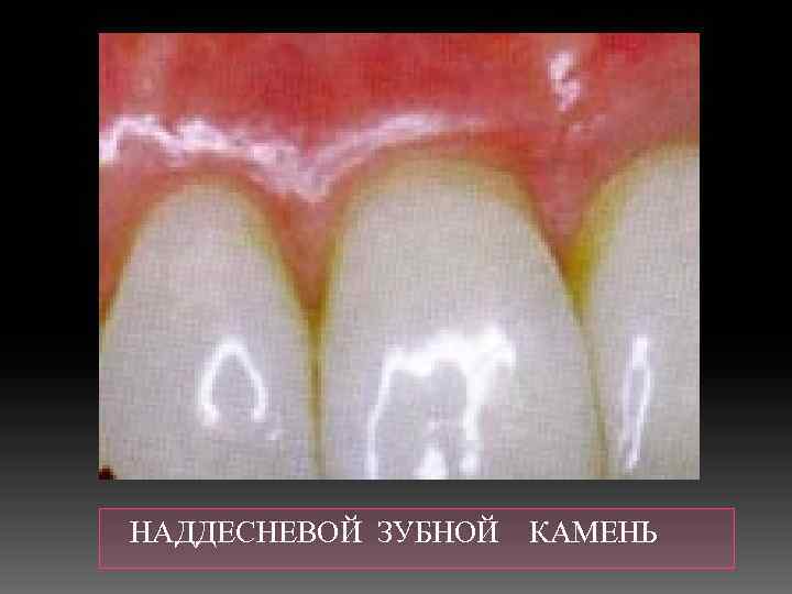  НАДДЕСНЕВОЙ ЗУБНОЙ КАМЕНЬ 