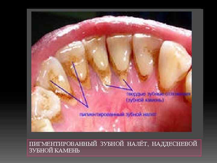 Наддесневой зубной камень фото