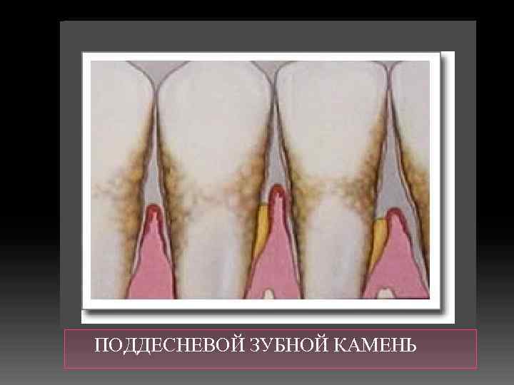  ПОДДЕСНЕВОЙ ЗУБНОЙ КАМЕНЬ 