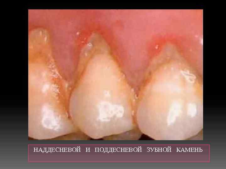  НАДДЕСНЕВОЙ И ПОДДЕСНЕВОЙ ЗУБНОЙ КАМЕНЬ 