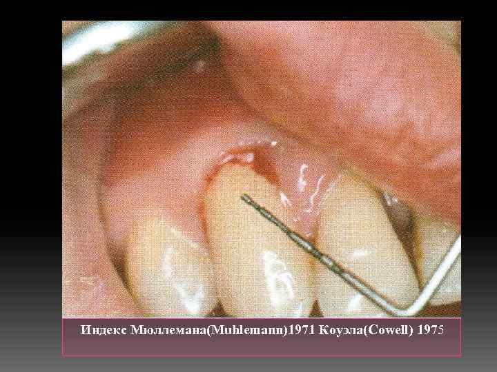 Индекс Мюллемана(Muhlemann)1971 Коуэла(Cowell) 1975 