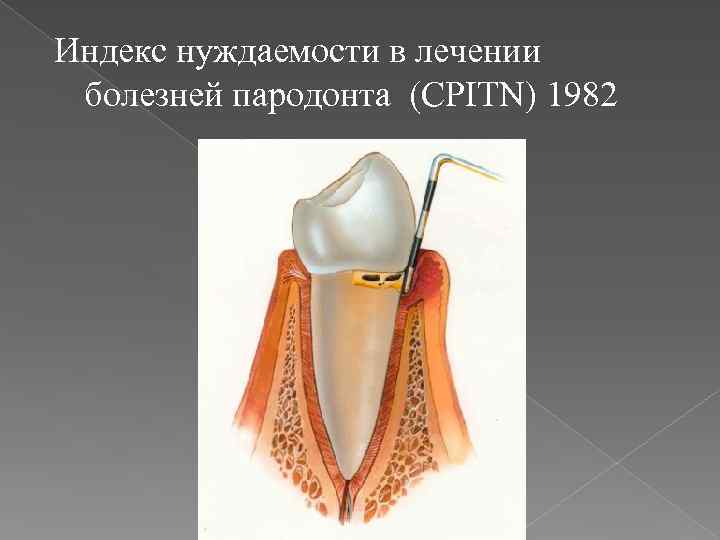 Пародонтальные индексы. Пародонтальный индекс CPITN. Индексы для оценки состояния тканей пародонта. Индекс нуждаемости в лечении заболеваний пародонта. CPI индекс пародонта.