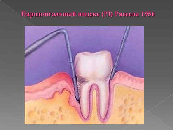 Пародонтальный индекс (PI) Рассела 1956 