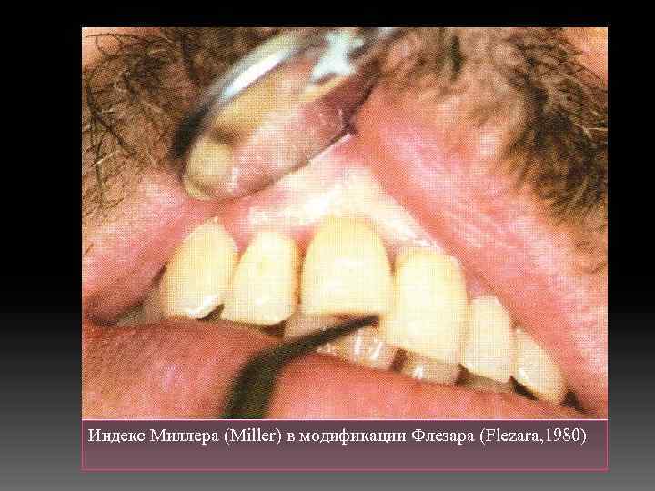 Индекс Миллера (Miller) в модификации Флезара (Flezara, 1980) 