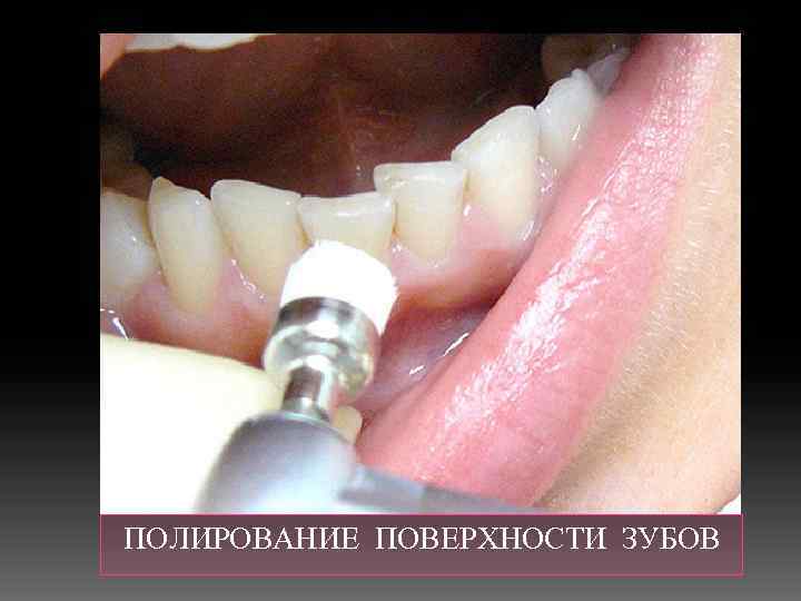  ПОЛИРОВАНИЕ ПОВЕРХНОСТИ ЗУБОВ 