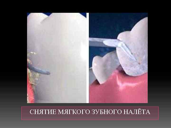  СНЯТИЕ МЯГКОГО ЗУБНОГО НАЛЁТА 
