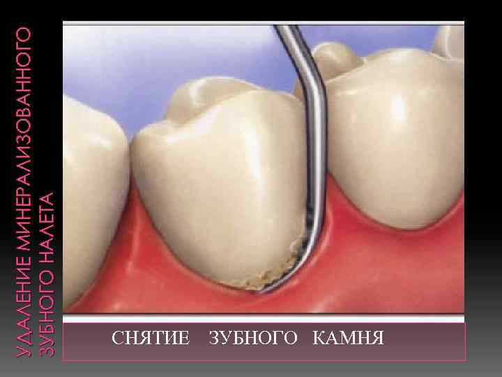УДАЛЕНИЕ МИНЕРАЛИЗОВАННОГО ЗУБНОГО НАЛЕТА СНЯТИЕ ЗУБНОГО КАМНЯ 
