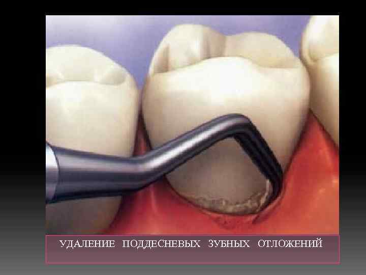  УДАЛЕНИЕ ПОДДЕСНЕВЫХ ЗУБНЫХ ОТЛОЖЕНИЙ 