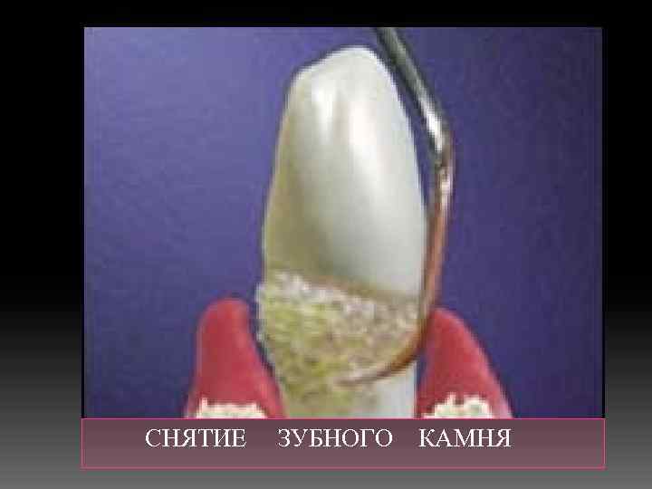  СНЯТИЕ ЗУБНОГО КАМНЯ 