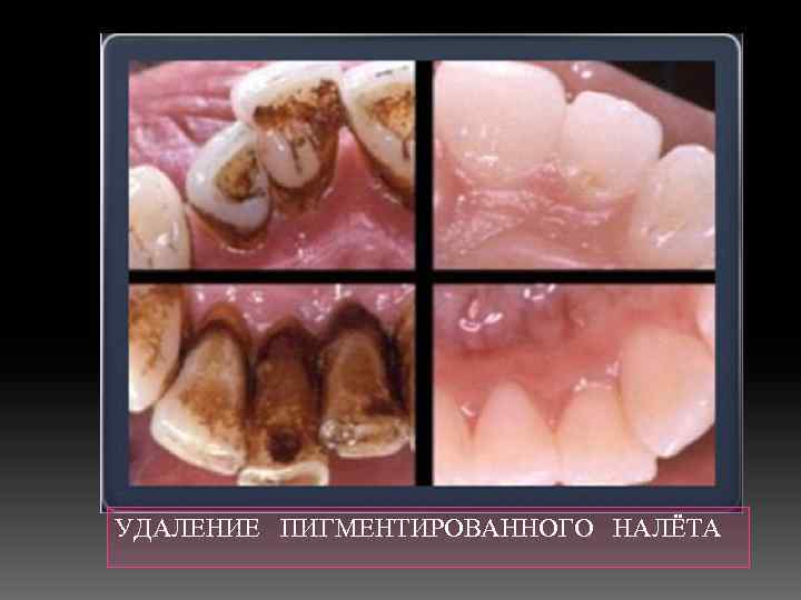 УДАЛЕНИЕ ПИГМЕНТИРОВАННОГО НАЛЁТА 