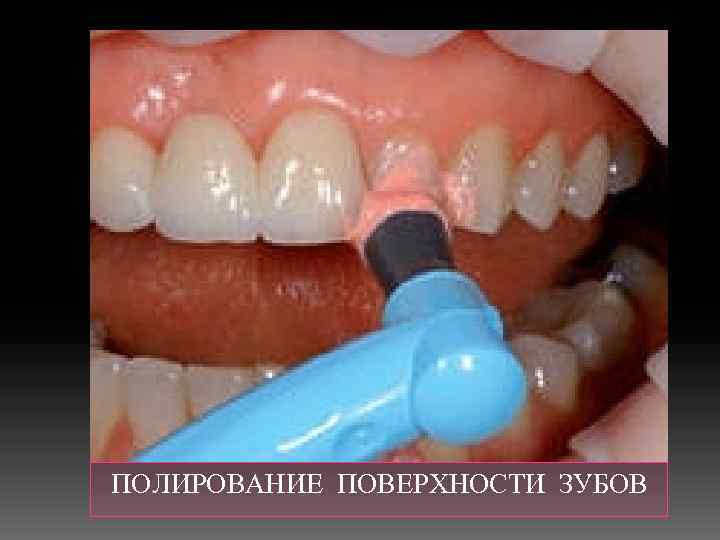  ПОЛИРОВАНИЕ ПОВЕРХНОСТИ ЗУБОВ 