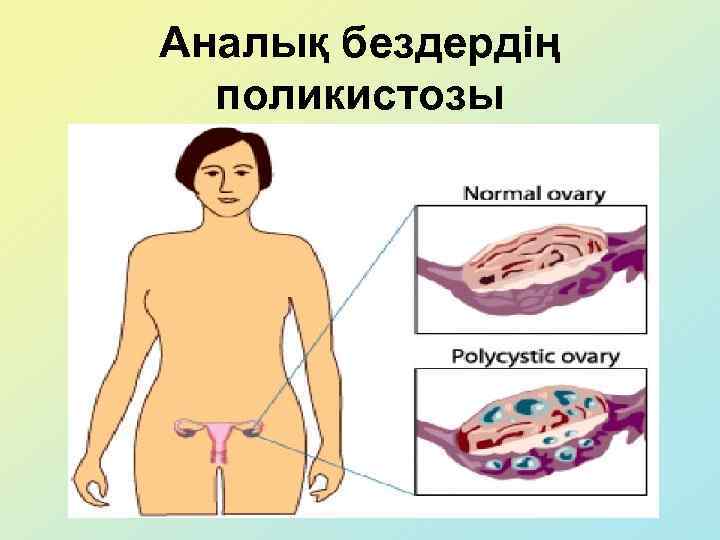 Аналық бездердің поликистозы 